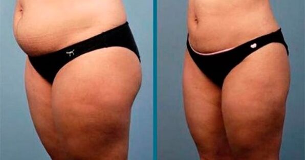 metode pentru a pierde în greutate cu 10 kilograme într-o lună